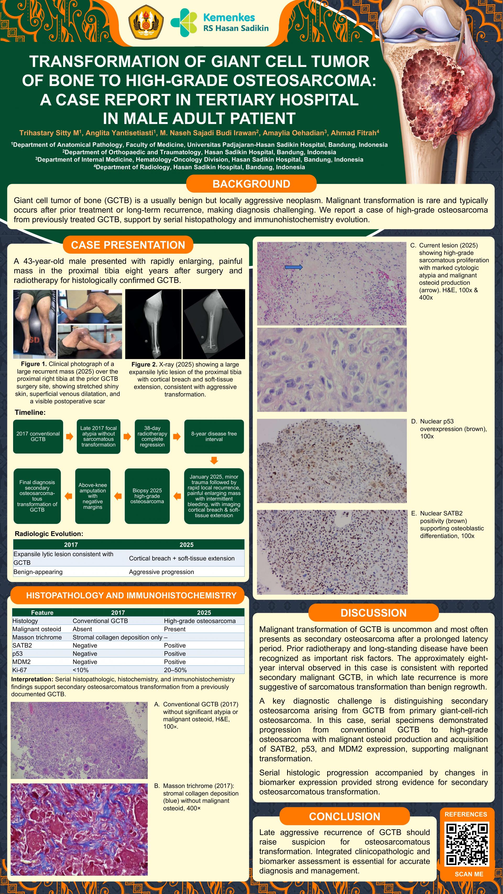 Transformation of Giant Cell Tumor of Bone to High-Grade Osteosarcoma:A Case Report in Tertiary Hospital in Male Adult Patient